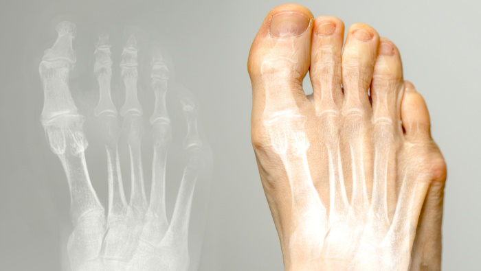 Síntomas del bulto en el dedo menique del pie